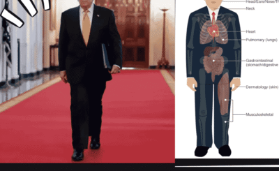Donald Trump Disease Explained What Is Chronic Venous Insufficiency